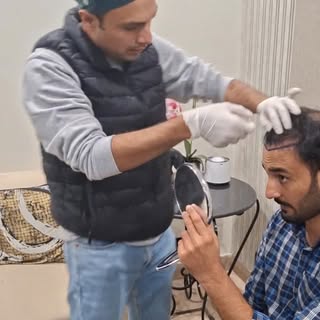 Hair Transplant by Dr Burhan Ashraf 0092 308 1423186 
#hairtransplant #hairtransplantsurgeon #hairre