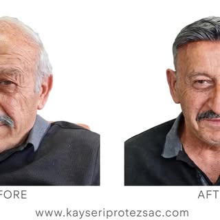 kayseriprotezsac Ali Güler