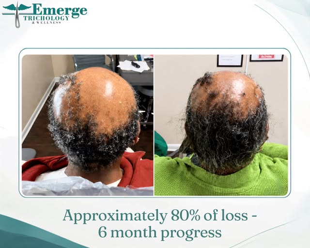 After years of clinical experience, we’ve seen many patients with long-standing alopecia achieve mea