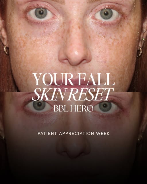Sun spots, redness, uneven skin tone? BBL may be your answer. ✨

BBL (BroadBand Light) is a light-ba