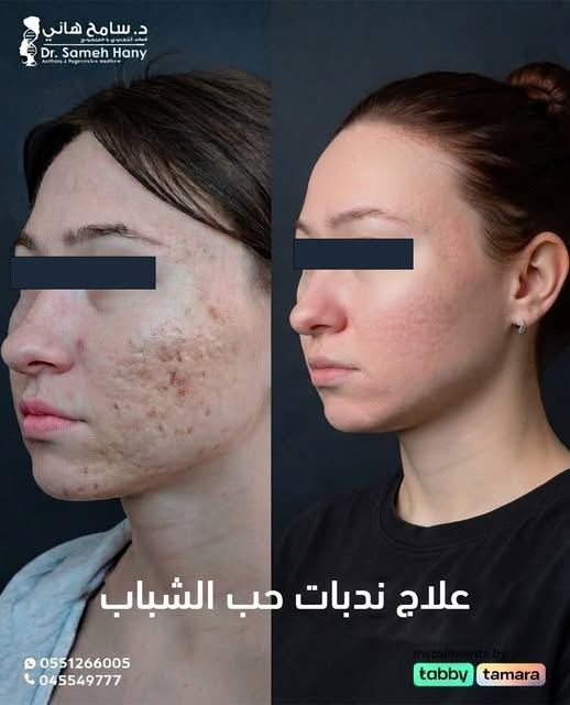 📞 استشارتك علينا
📍 نيو مي كلينك – مدينة دبي الطبية
☎️ للحجز والتواصل: 0551266005