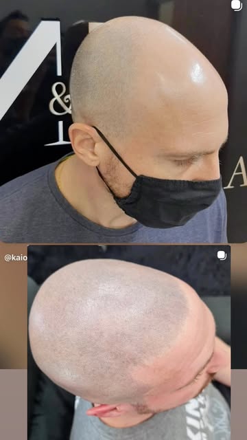 PARECE CABELO RASPADO. MAS É MICROPIGMENTAÇÃO. 🔥

Olha esse ANTES e DEPOIS. 👀

Pontos extremamente