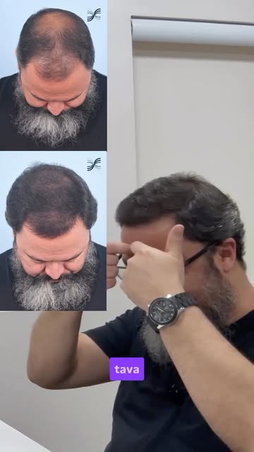 O melhor transplante capilar é aquele que ninguém percebe que você fez.

Aos 5 meses de evolução, ai