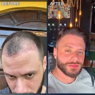 A transformação do @mag_mateus após o transplante capilar está simplesmente perfeita! 🎉
▪️ Envie-no