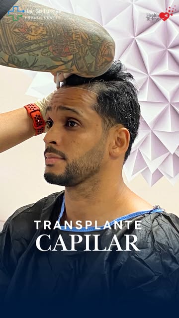 O transplante capilar é um procedimento que pode ser considerado por pessoas que enfrentam queda ou 