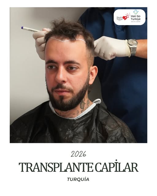 A queda de cabelo pode causar, com o tempo, alterações na linha capilar e na densidade dos fios. O t