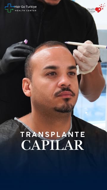 A Turquia é um dos destinos procurados por pessoas de diferentes países para o transplante capilar. 