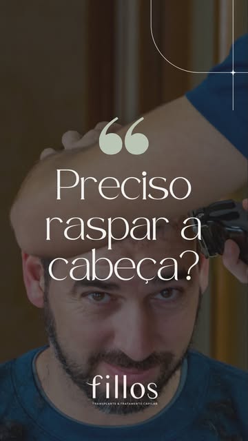 Se você tem calvície grau 1, pode fazer um transplante capilar sem precisar raspar toda a cabeça, op