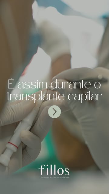 Na Fillos Transplante Capilar, priorizamos excelência e tecnologia em todos os procedimentos. Utiliz