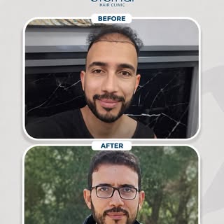 Precision begins with the plan.

A personalized hairline, careful planning, and attention to every d