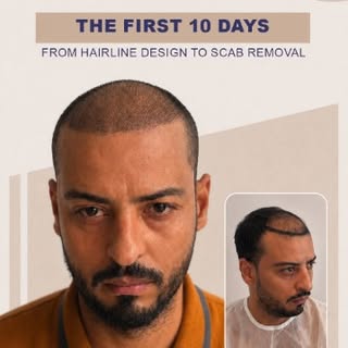 The first days after a hair transplant are all about careful recovery.

From the initial hairline de