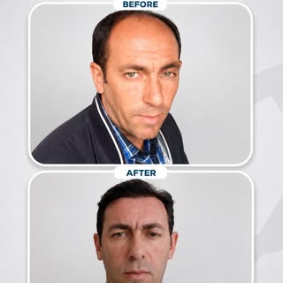 Precision starts before the first graft is placed.

A carefully designed hairline, a personalized tr