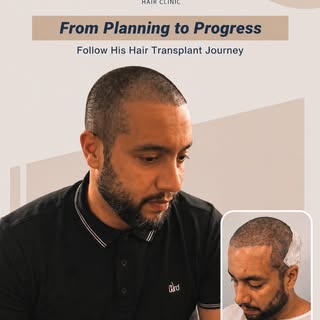 Every hair transplant journey starts with a personalized approach.

From careful planning to precise