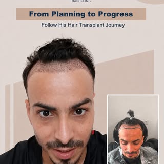 One journey. Two areas. One personalized approach.

From hair to beard, every step of this patient's