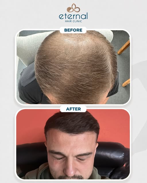 A closer look at this transformation.
This Before & After shows what happens when a hair transplant 