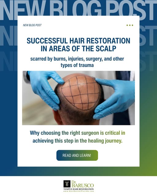 Successful #HairRestoration in areas of the scalp scarred by burns, injuries, surgery, and other typ