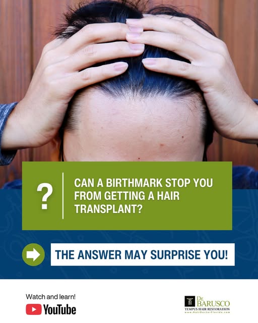 Can a birthmark stop you from getting a #HairTransplant? The answer may surprise you! Dr. Marco Baru