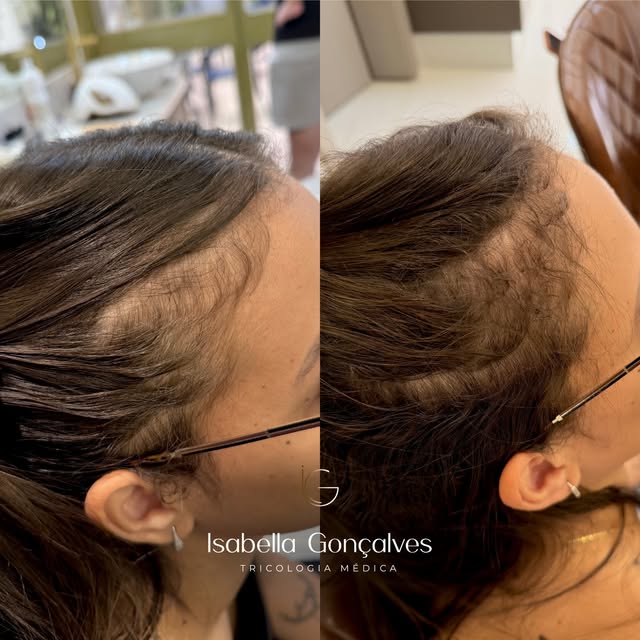 A queda de cabelo no pós-parto pode ser desesperadora e uma das regiões que mais incomodam é justame