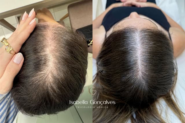 6 meses de tratamento. ✨

Paciente com diagnóstico de alopecia padrão feminino (calvície feminina), 