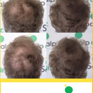 Scalp Micropigmentation is a non invasive hair loss solution which can give the illusion of more hai