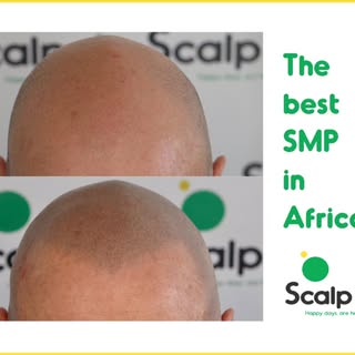 Scalp Micropigmentation or SMP is a non invasive hair loss solution which can give the look of a ful