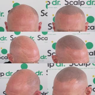 Scalp Micropigmentation is a non invasive hair loss solution which can give the look of a full head 