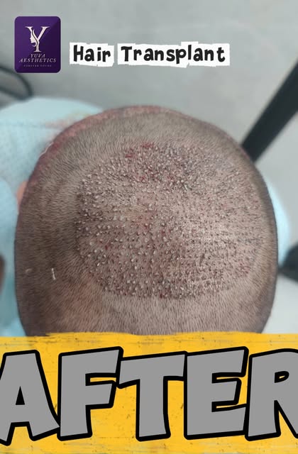 ✨ HAIR TRANSPLANT — RESTORE YOUR CONFIDENCE ✨

Struggling with hair loss? Take the first step toward