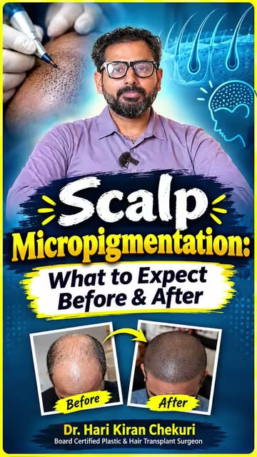 ✨ SCALP MICROPIGMENTATION — EXPLAINED ✨

Thinking about a fuller-looking hairline without surgery? S
