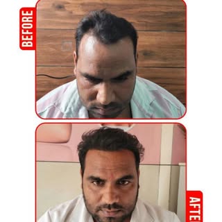 TIRED OF HAIR LOSS?
GET YOUR CONFIDENCE BACK!

HAIR TRANSPLANT STARTING AT JUST ₹29,999/

📞 𝐂𝐚𝐥�