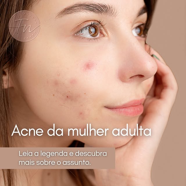 Você achou que a acne tinha ficado na adolescência?

Ela pode voltar — ou até começar — na vida adul