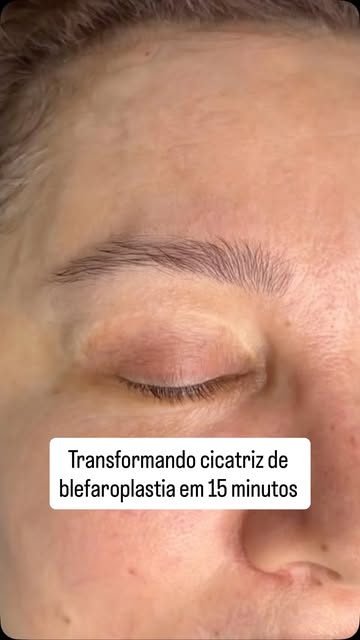 Você fez aquela tão sonhada cirurgia e ficou com a cicatriz em evidência e eu entendo o quanto isso 