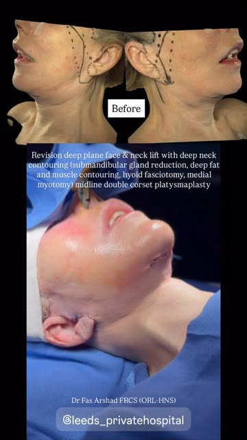 A great facelift isn’t just about tightening the skin — sometimes, achieving the best result means u