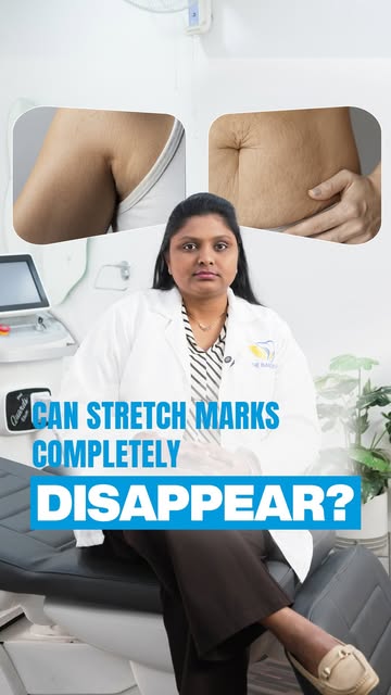 Stretch marks don’t need to be something you simply “learn to live with.”

With the right assessment