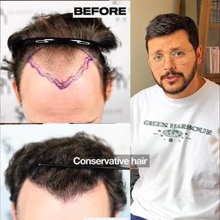 Our patient came to us wanting to restore his previous hairline and also be able to age well with it