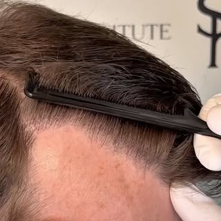 Whole scalp with around 4100 grafts!

Our patient was here 1.5 years ago and we did a larger procedu
