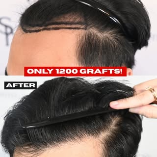 A natural hairline is all about precision and understanding how to distribute grafts based on each i