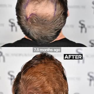 This is a 7.5-month progress update, with further growth still expected.

The patient had some nativ
