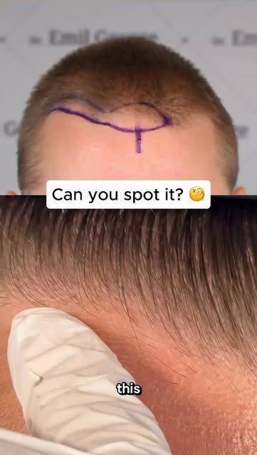 One of the most undetectable cases I’ve ever seen. Done by @dremilgeorge with only 830 Grafts! 🤩 #h