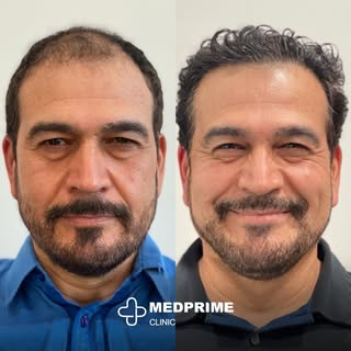 From Canada to Turkey, our journey is built on precision and care. Witness the remarkable transforma