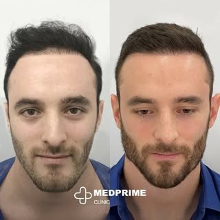 Canadian excellence meets Turkish innovation in hair restoration! 🌟🍁 Proudly leading the way!