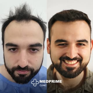 Experience the difference expertise makes! Our track record of exceptional hair transplant results r