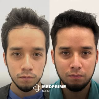 As the first Canadian clinic in Turkey, our commitment to excellence shines in every hair transplant