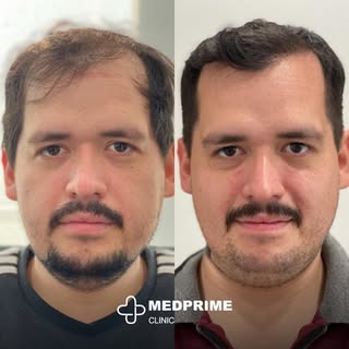 Experience the art of hair restoration, where Canadian precision meets the warmth of Turkish hospita