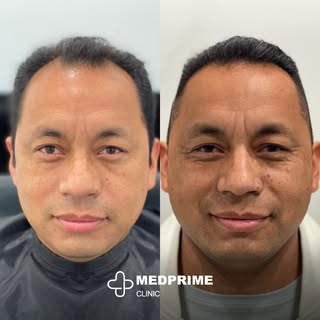 From thinning to thriving! Our team's proficiency in hair restoration ensures seamless transitions a