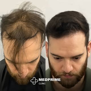 At our clinic, it's all about skill and precision. Our expertise in hair transplantation guarantees 