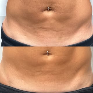 1 MONTH POST XERF ✨

And we’re just getting started 👏🏼

At just 4 weeks, we’re already seeing a sm