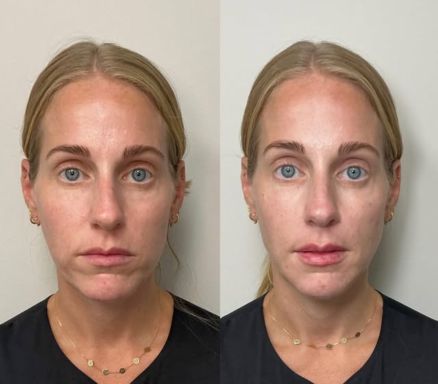 EZ Gel full face + lip maintenance
Areas treated:
Mid face
Under eyes
Jawline / pre auricular 
Chin 