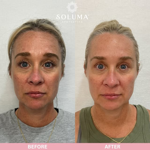 We know Chemical Peels can seem daunting at first, a lot of people fear excessive peeling for long p