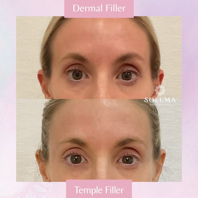 Many patients may not realize that temple filler is an option or think that they even need it in the