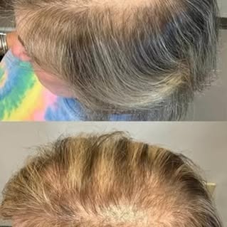 Our jaws are on the floor 😱 with these Alma TED results after only TWO treatments! 

👉Alma TED is 